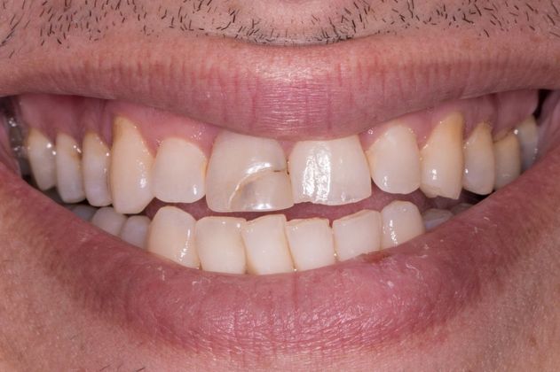 before dental crowns