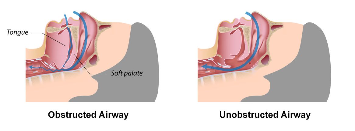 before and after sleep apnea treatment